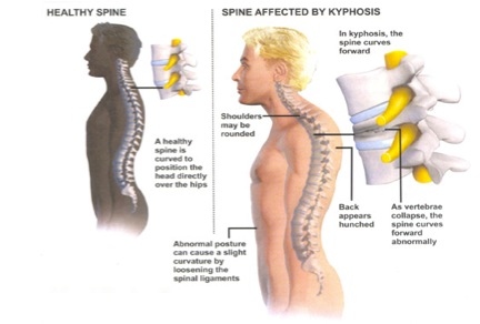 HyperKyphosis