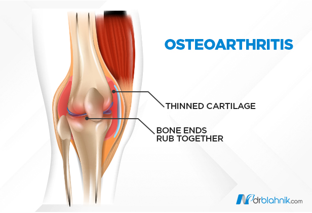 Osteoarthritis Pain