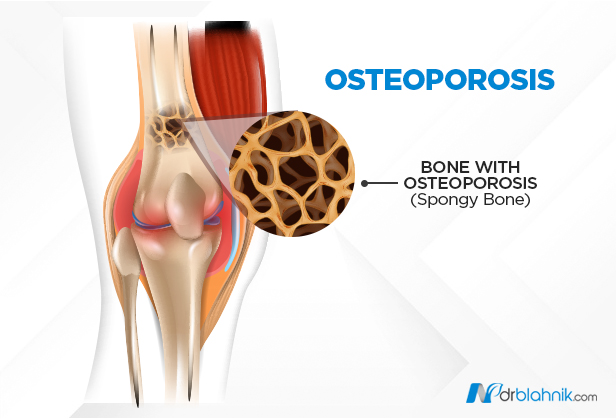 Osteoporosis Pain