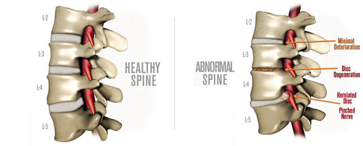 Healthy Spine Unhealthy Spine